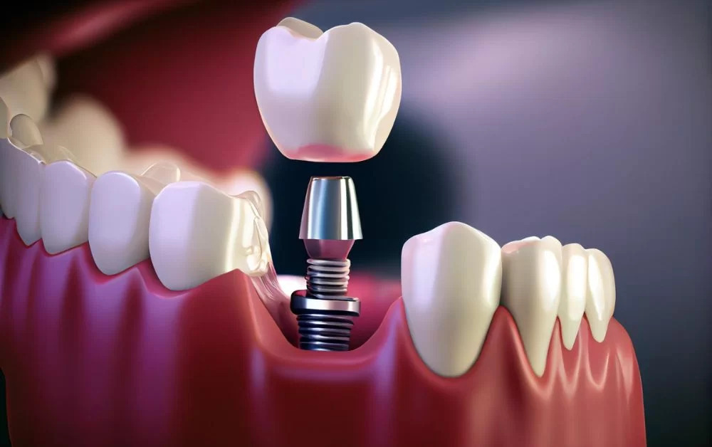 Exploring Dental Implants Treatment in Texas